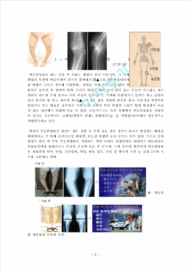 [의학,약학][의학] 고관절 전치술, 슬관절 전치술 -THR [Total Hip Replacement], TKR[Total Knee Replacement]   (2 )